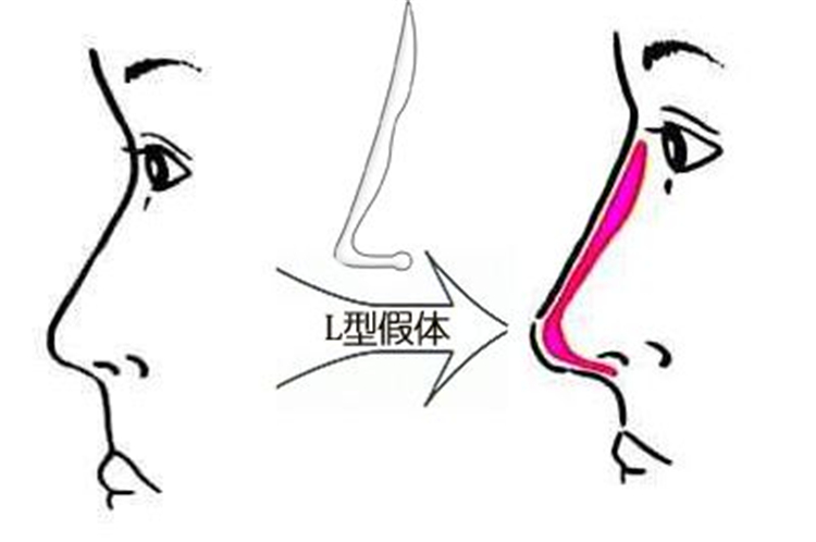 硅胶隆鼻